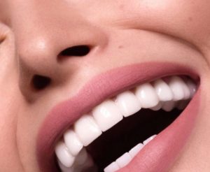 La dentisterie esthétique, la solution idéale pour parfaire votre sourire